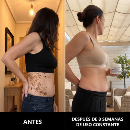 Antes y después, costado y cadera, 8 semanas