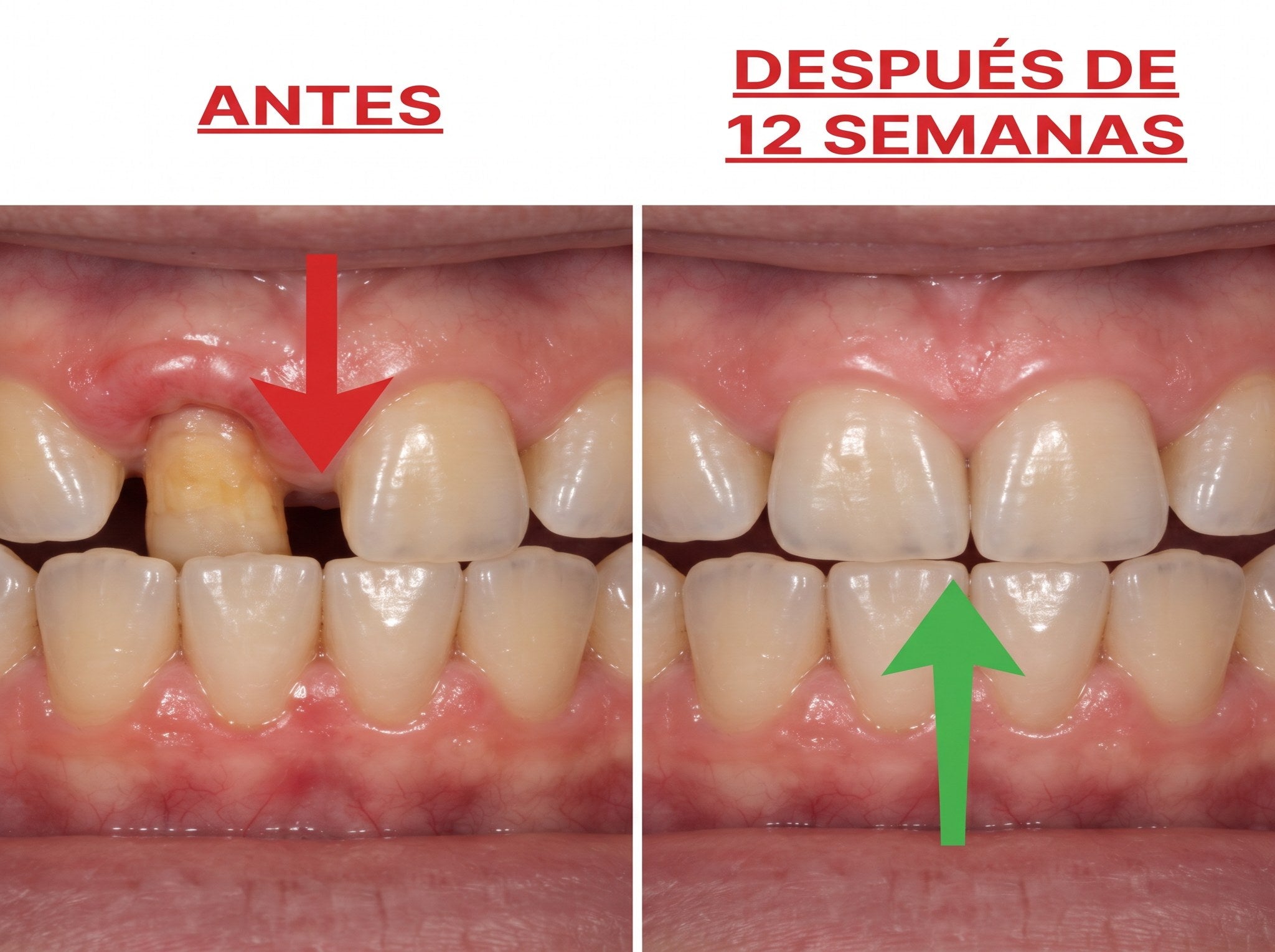 Línea de las encías antes y después de 12 semanas