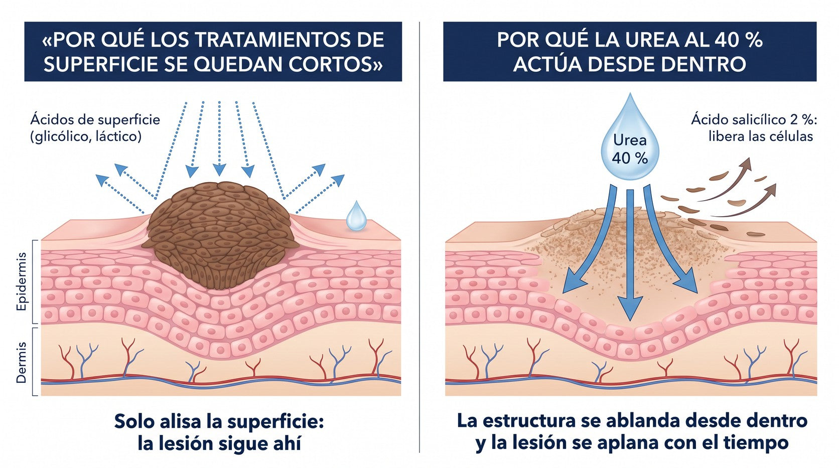 Diagrama de la queratólisis estructural